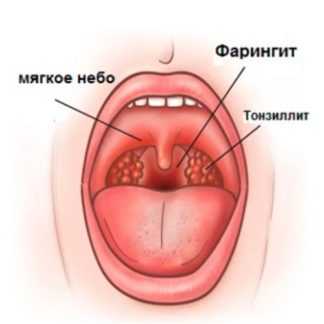 [Игорь Атрощенко] Диагностика и лечение тонзиллитов, ларингитов и фарингитов (2020)